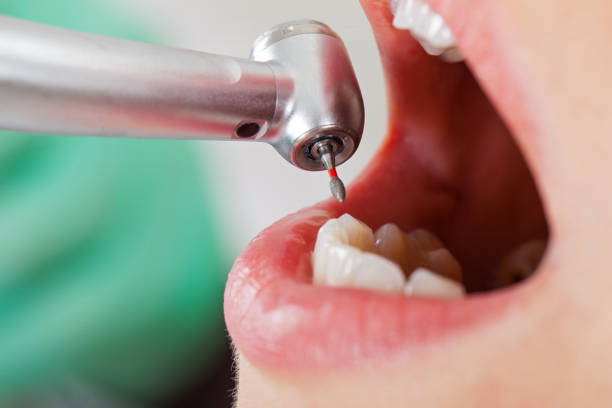 Best Emergency Wisdom Tooth Extraction in Red Rock, AZ